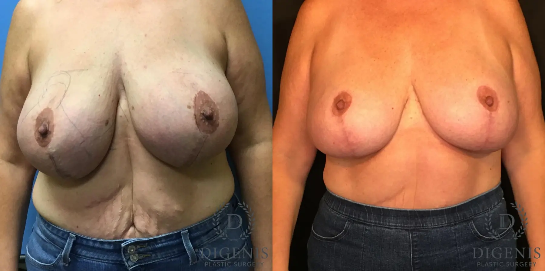 Breast Lift: Patient 10 - Before and After  