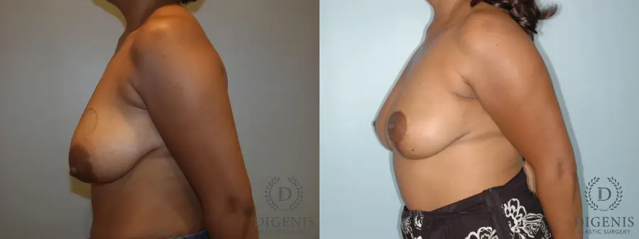 Breast Lift: Patient 2 - Before and After 3