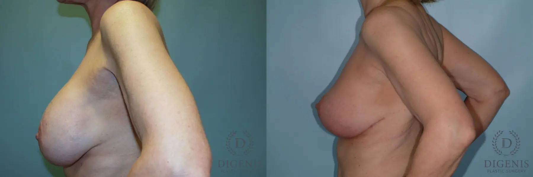 Breast Lift: Patient 16 - Before and After 5
