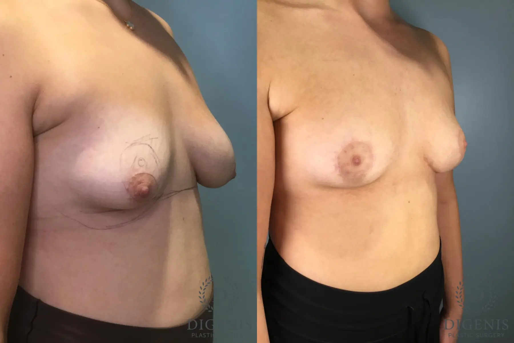 Breast Lift: Patient 7 - Before and After 2