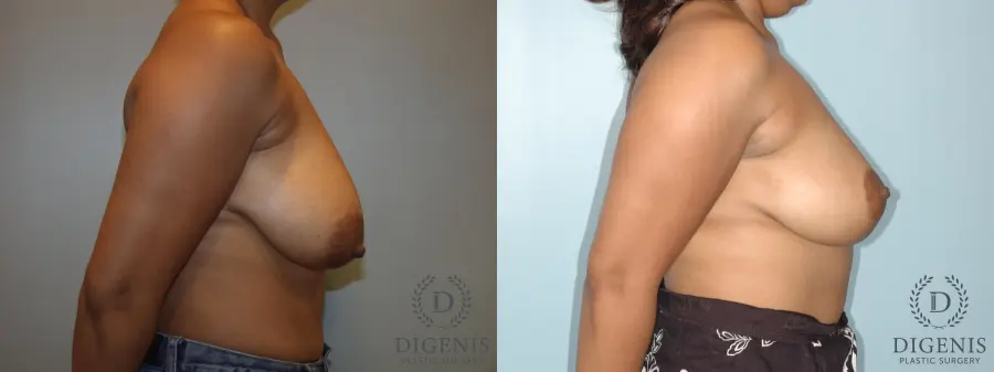 Breast Lift: Patient 2 - Before and After 2