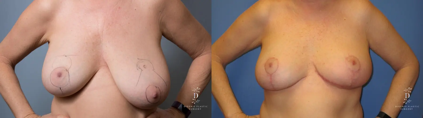 Breast Lift: Patient 6 - Before and After  