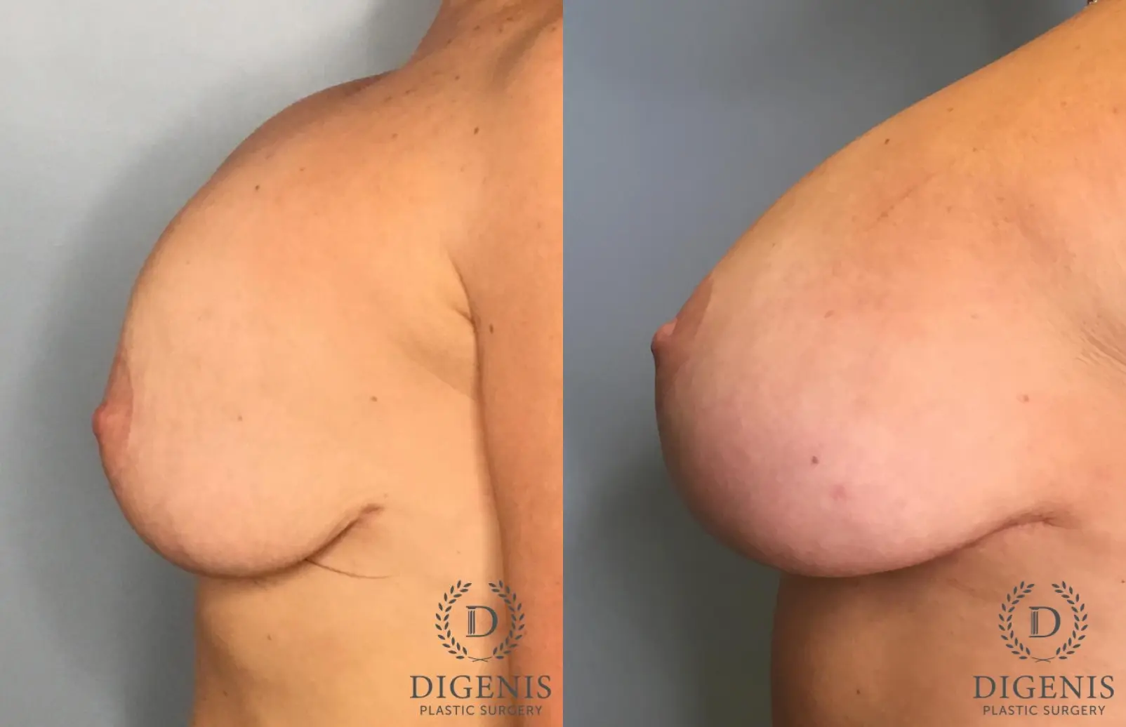 Breast Lift: Patient 43 - Before and After 5