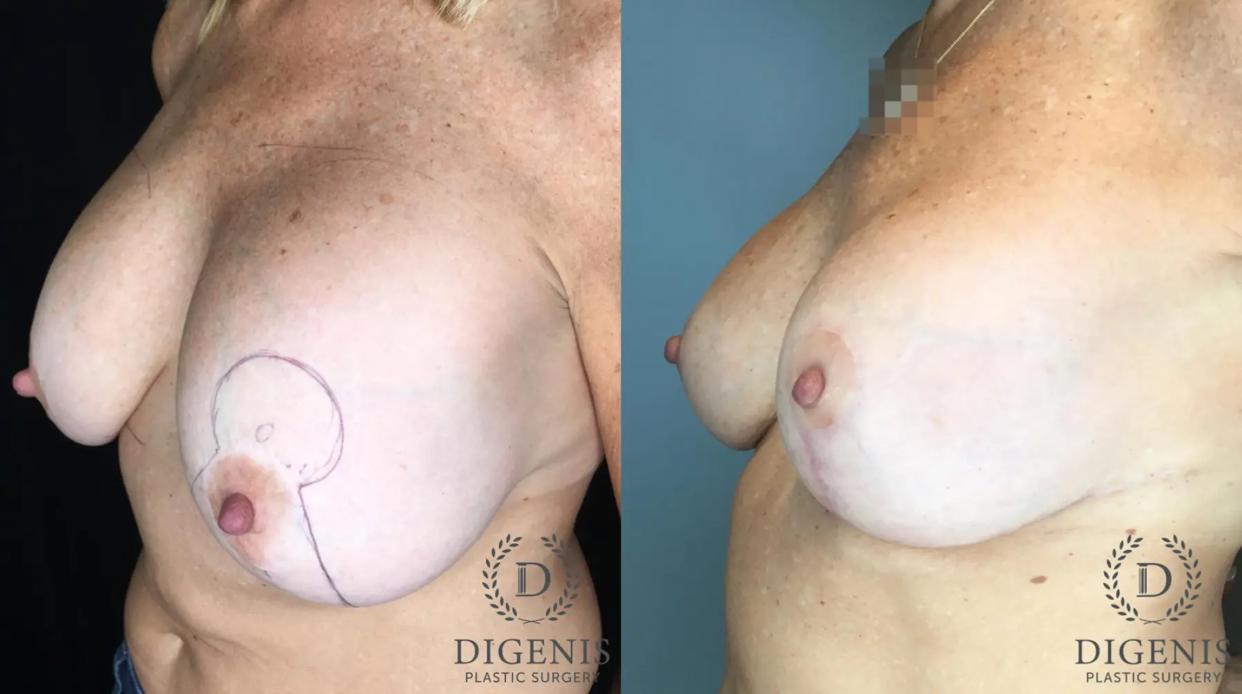 Breast Lift: Patient 45 - Before and After 2