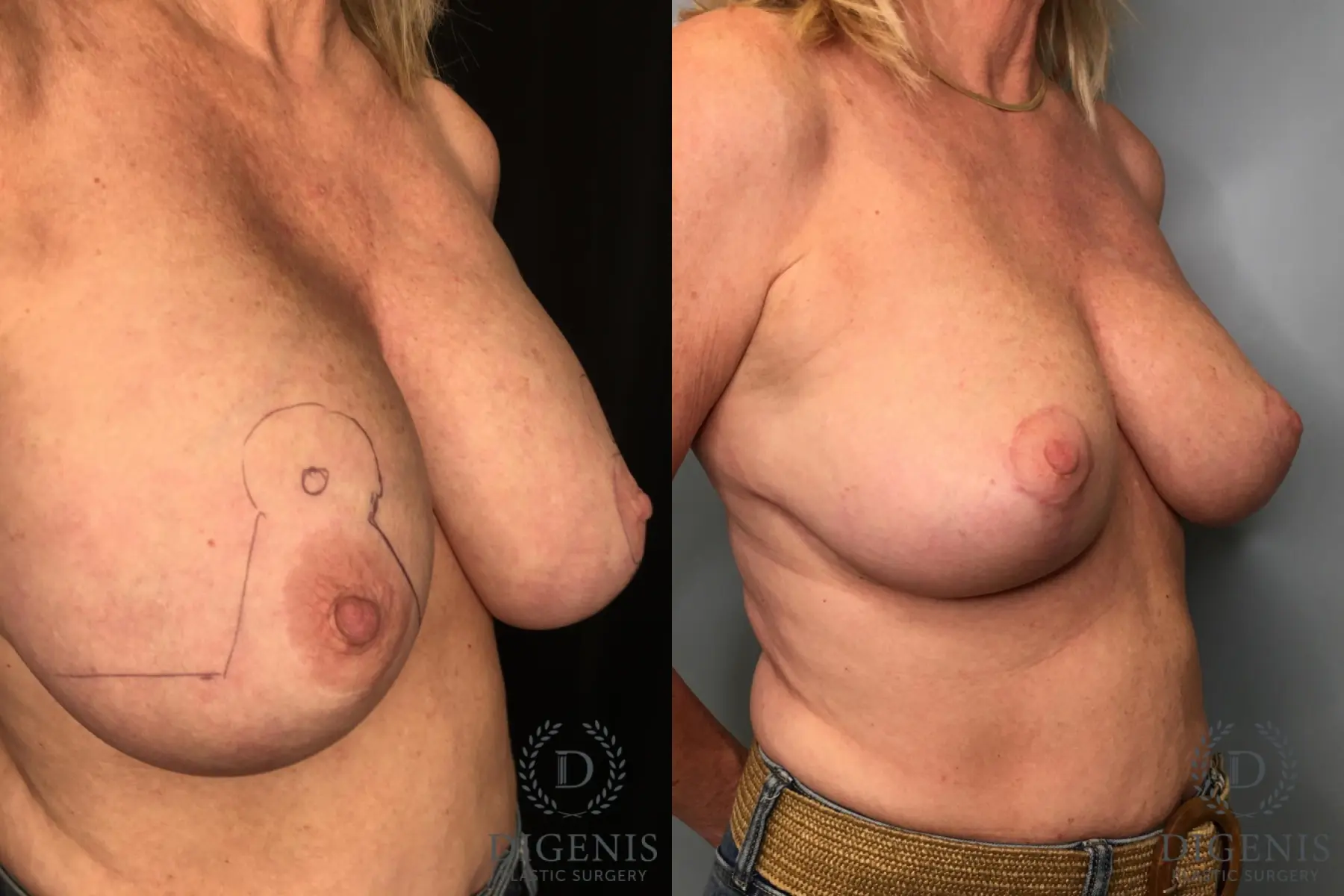 Breast Lift: Patient 32 - Before and After 2