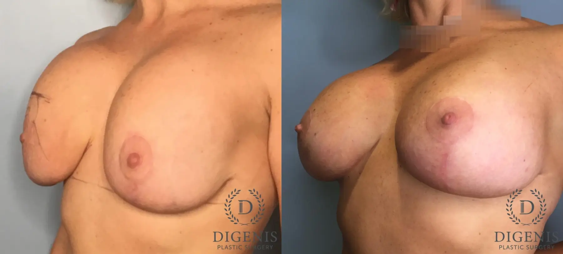 Breast Lift: Patient 43 - Before and After 4