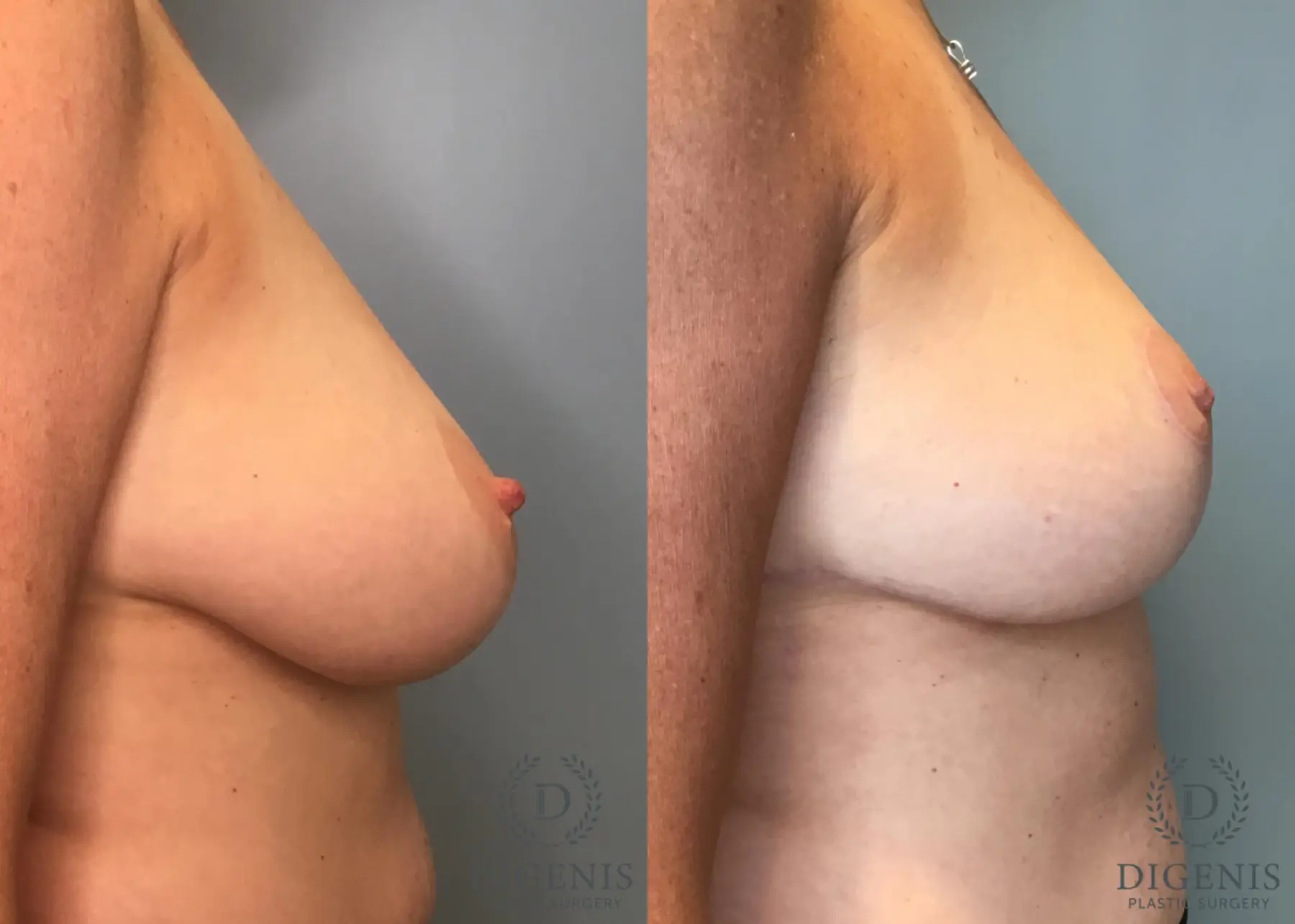 Breast Lift: Patient 46 - Before and After 3