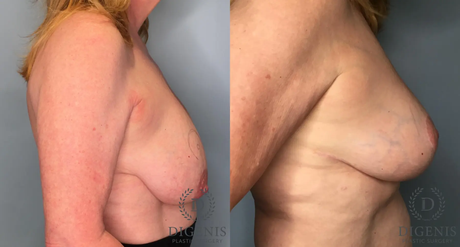 Breast Lift: Patient 6 - Before and After 5