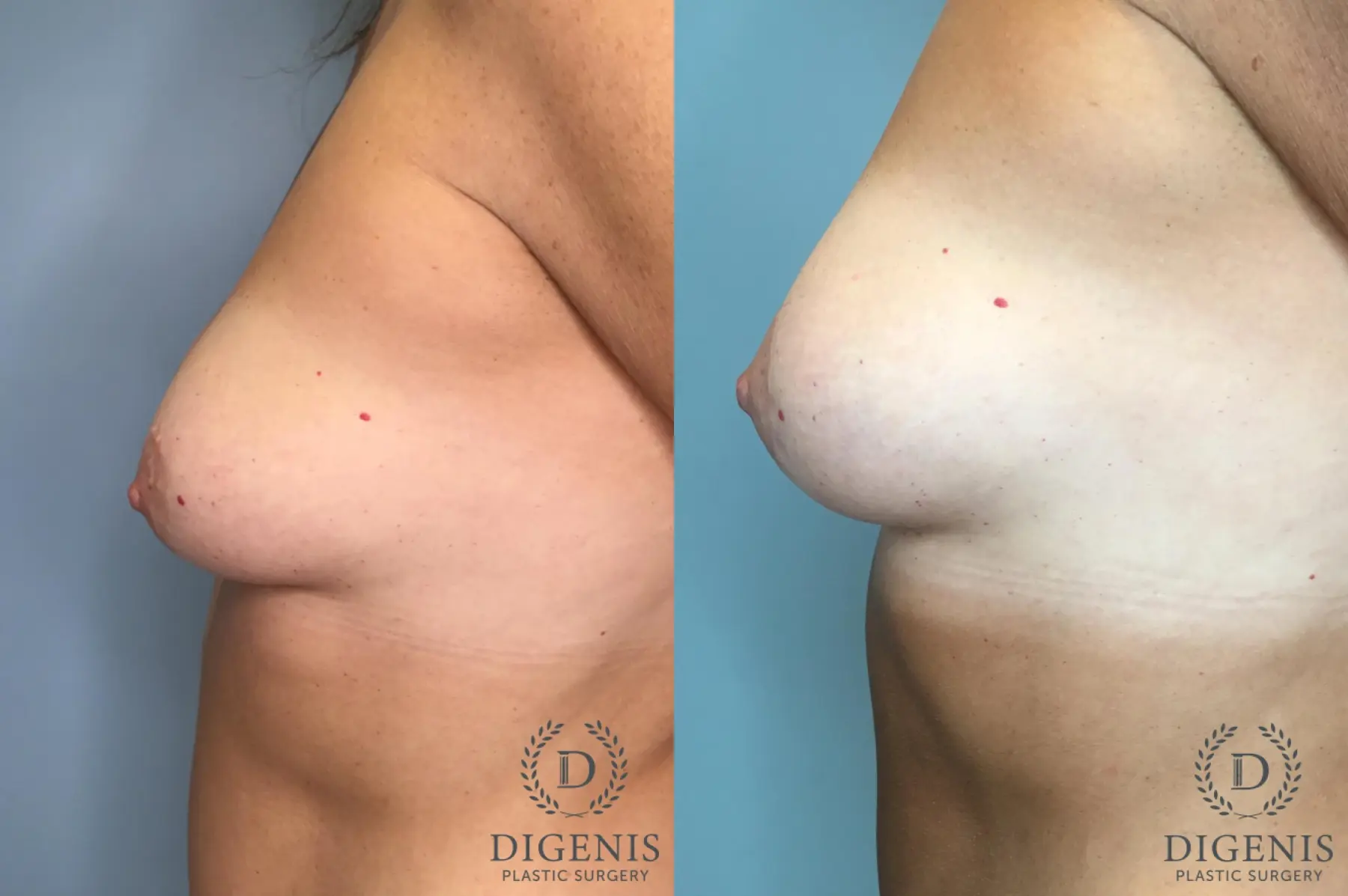 Breast Lift: Patient 30 - Before and After 4