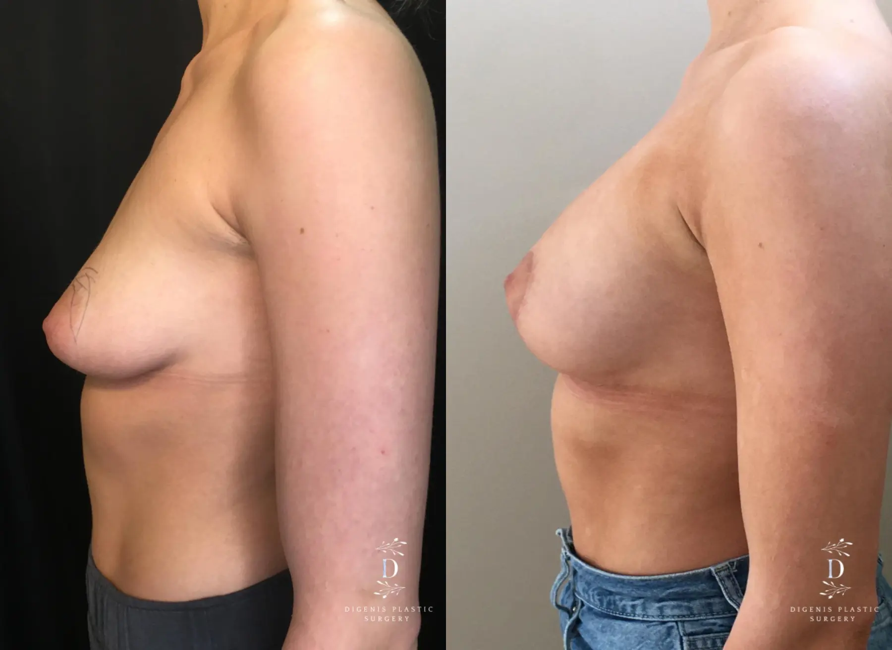 Breast Lift: Patient 29 - Before and After 5