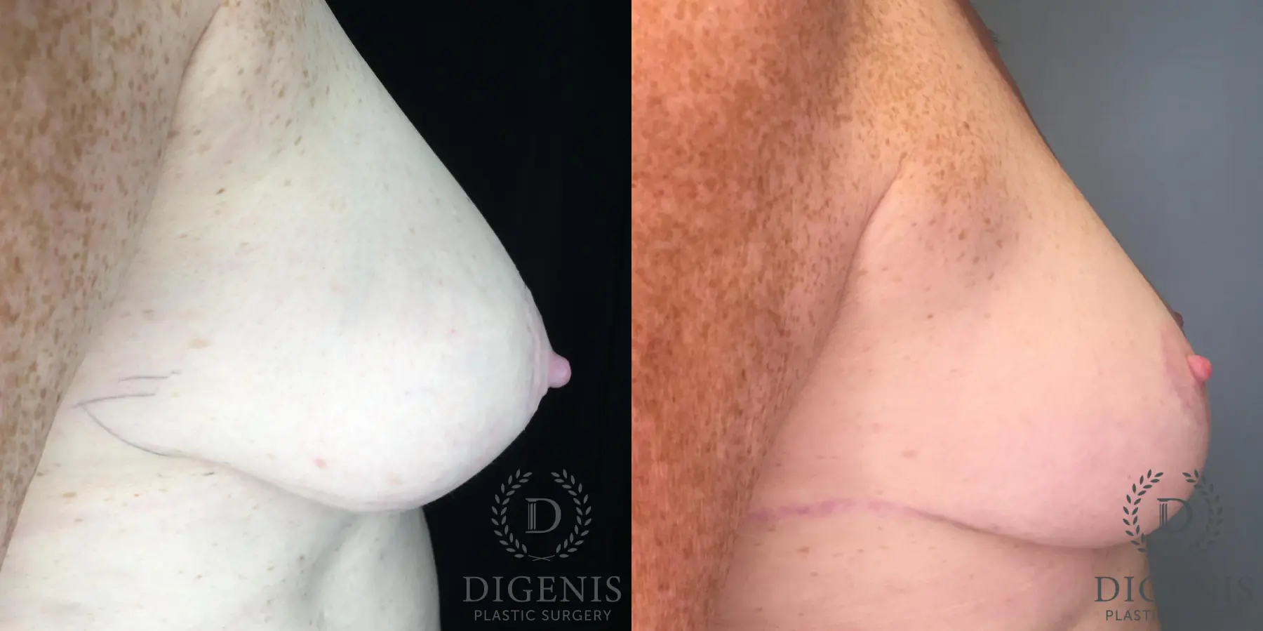 Breast Lift: Patient 35 - Before and After 5