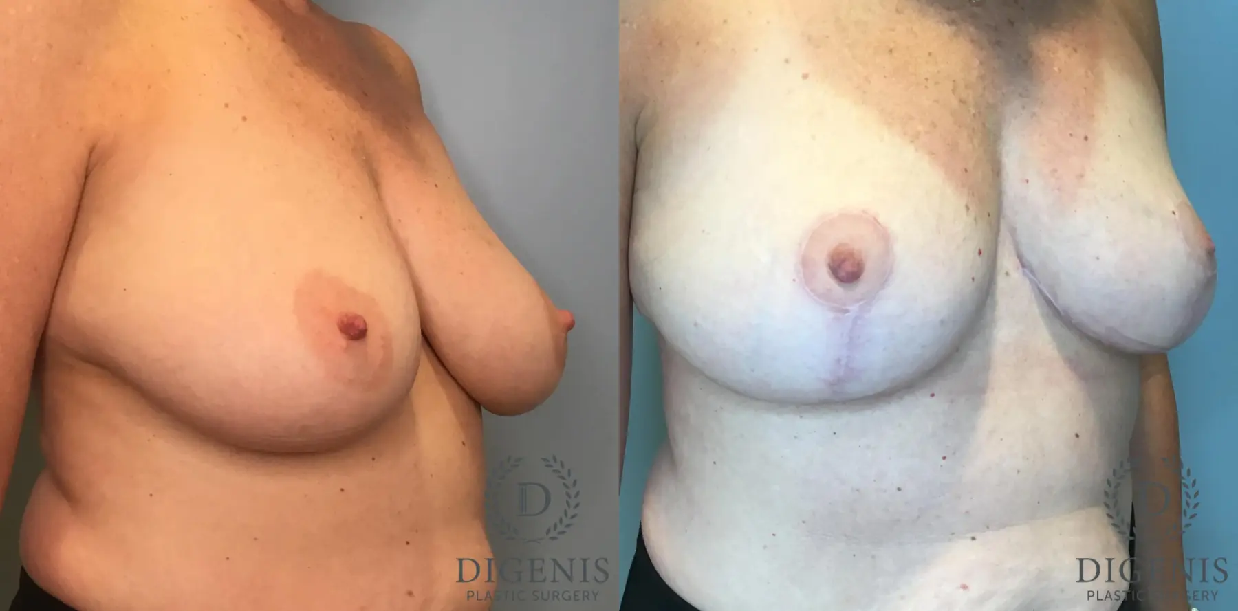 Breast Lift: Patient 46 - Before and After 2