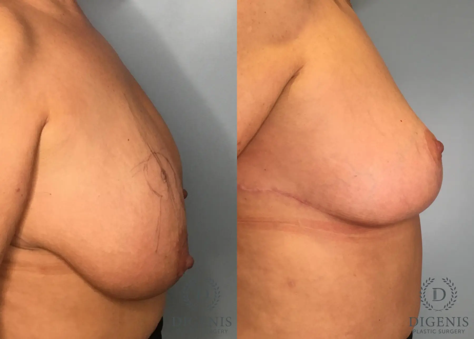 Breast Lift: Patient 44 - Before and After 3
