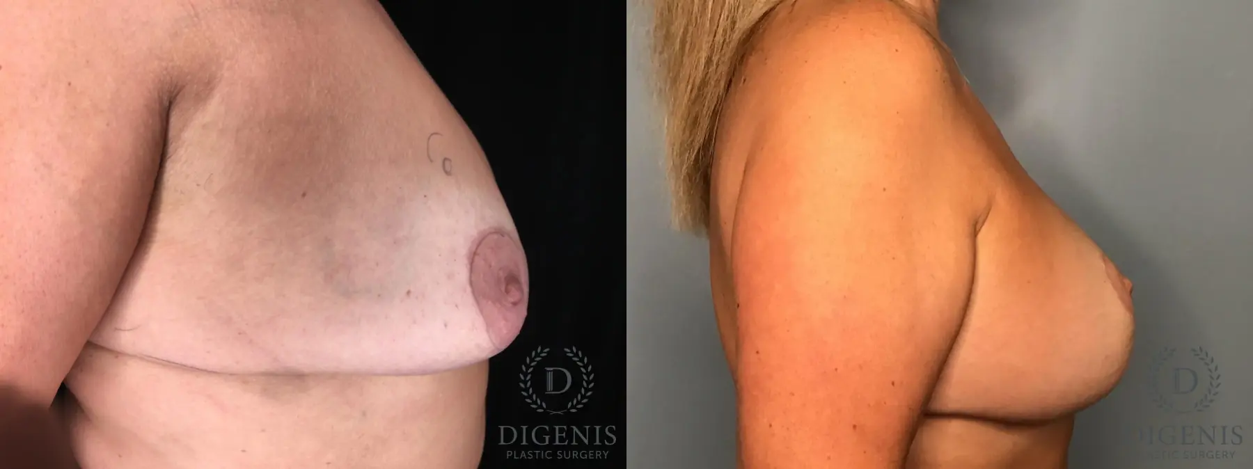 Breast Lift: Patient 33 - Before and After 5