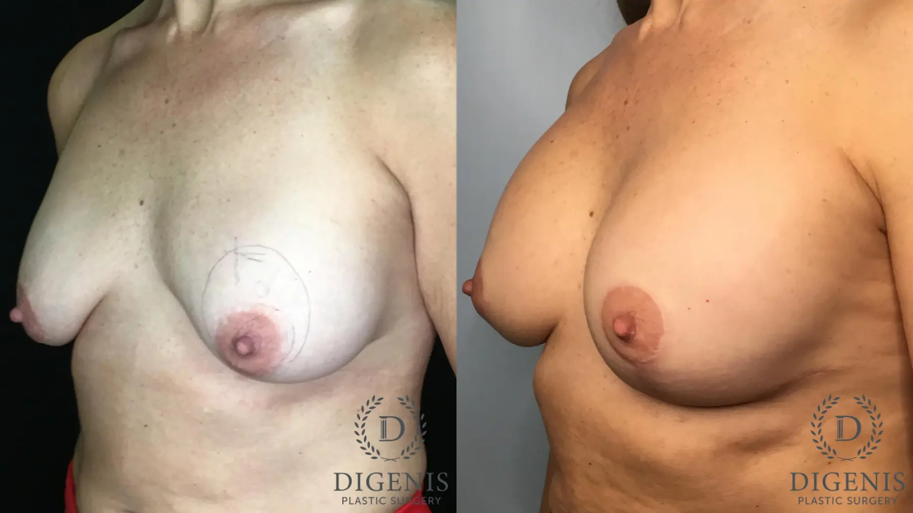 Breast Lift: Patient 37 - Before and After 2