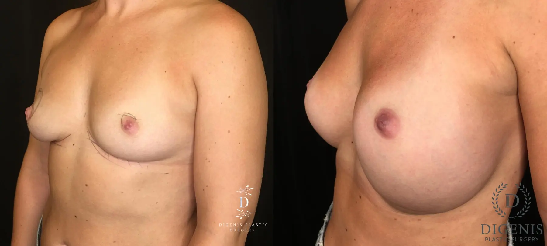 Breast Lift: Patient 24 - Before and After 4
