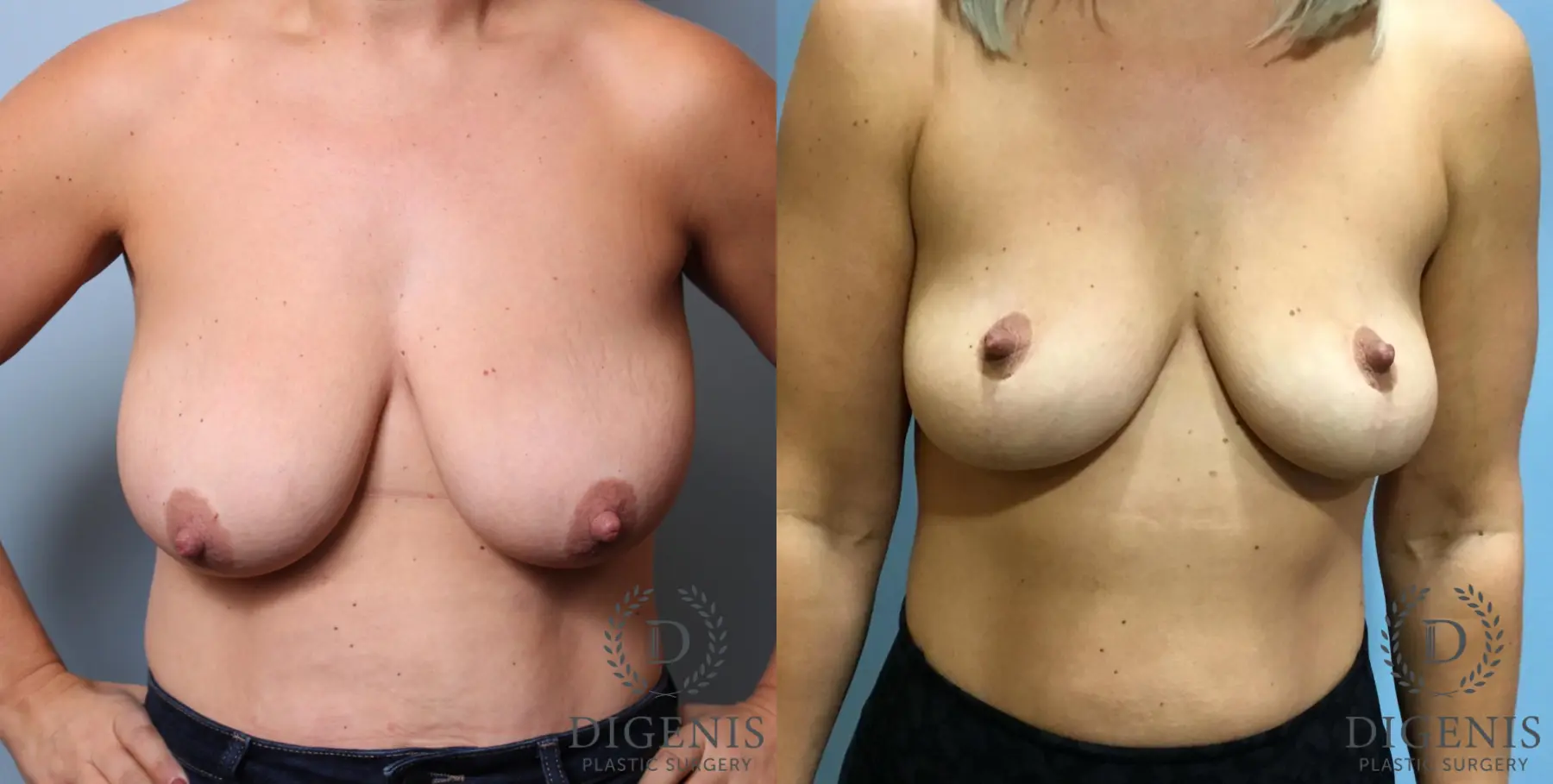 Breast Lift: Patient 4 - Before and After  