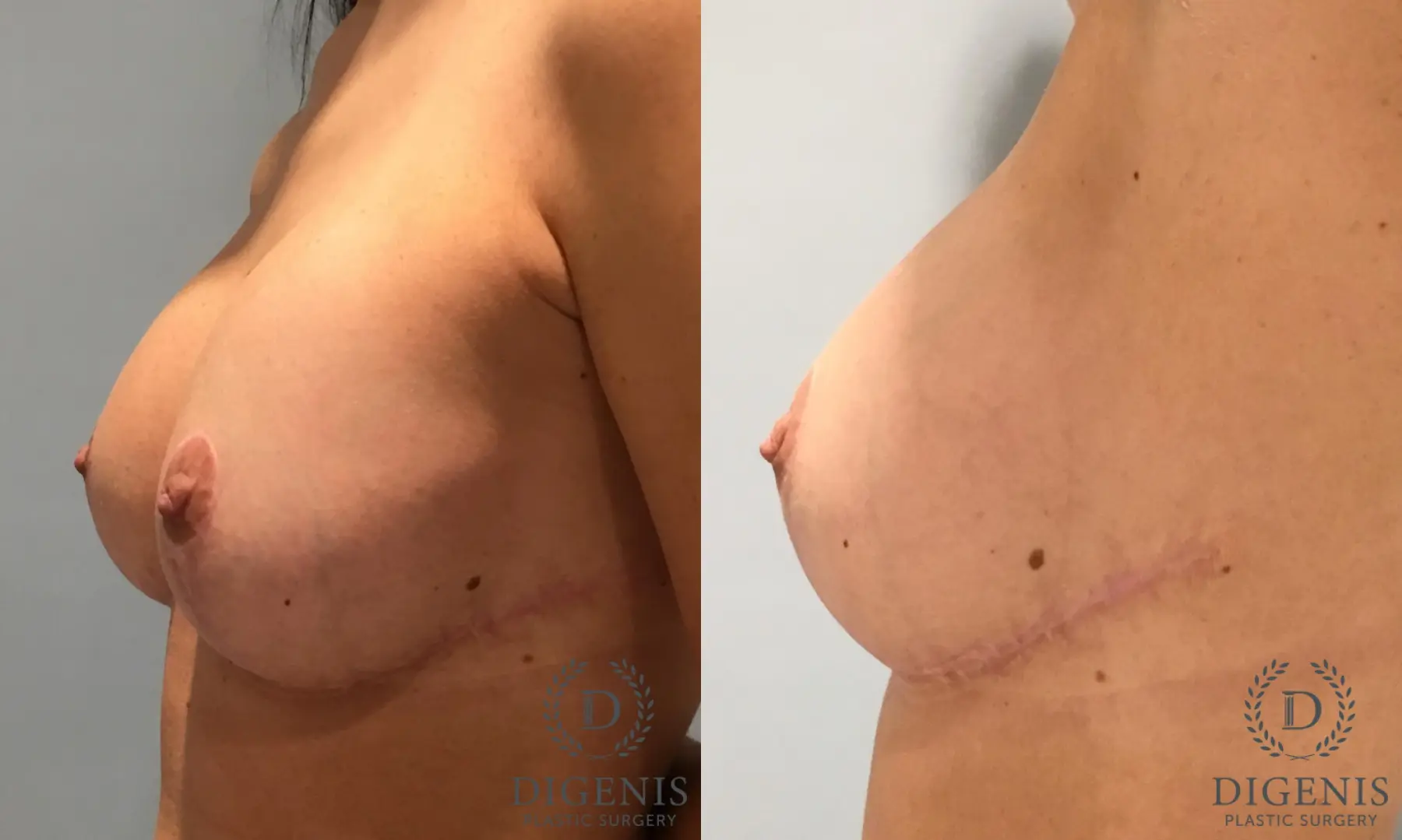 Breast Lift: Patient 40 - Before and After 2
