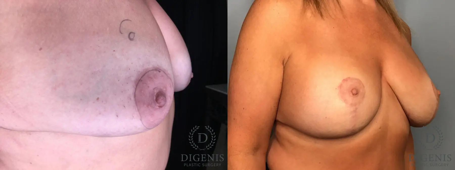 Breast Lift: Patient 33 - Before and After 4