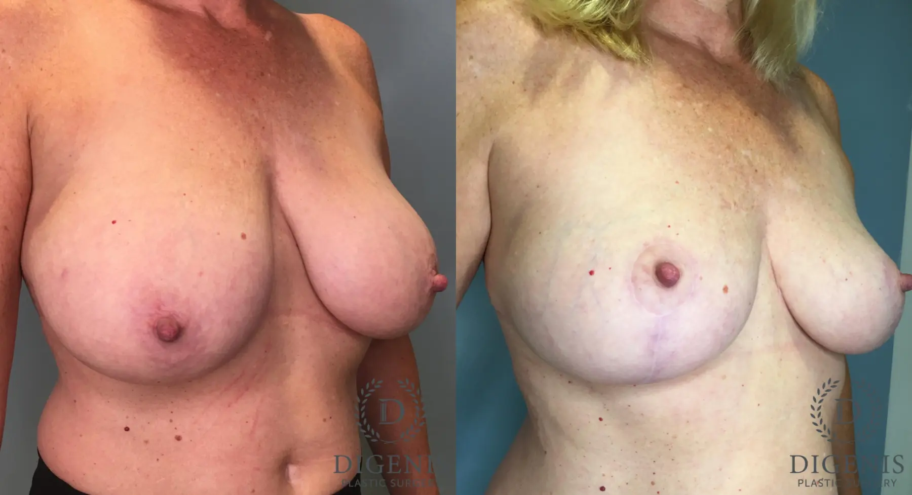 Breast Lift: Patient 39 - Before and After 2