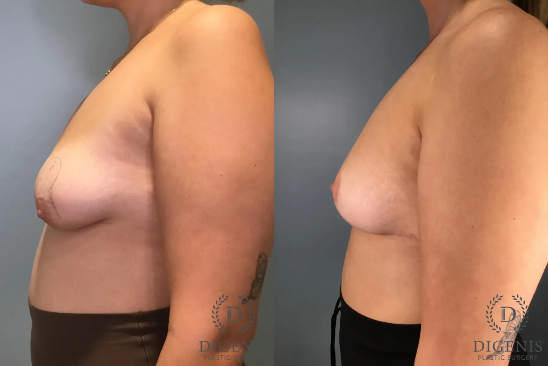 Breast Lift: Patient 7 - Before and After 5