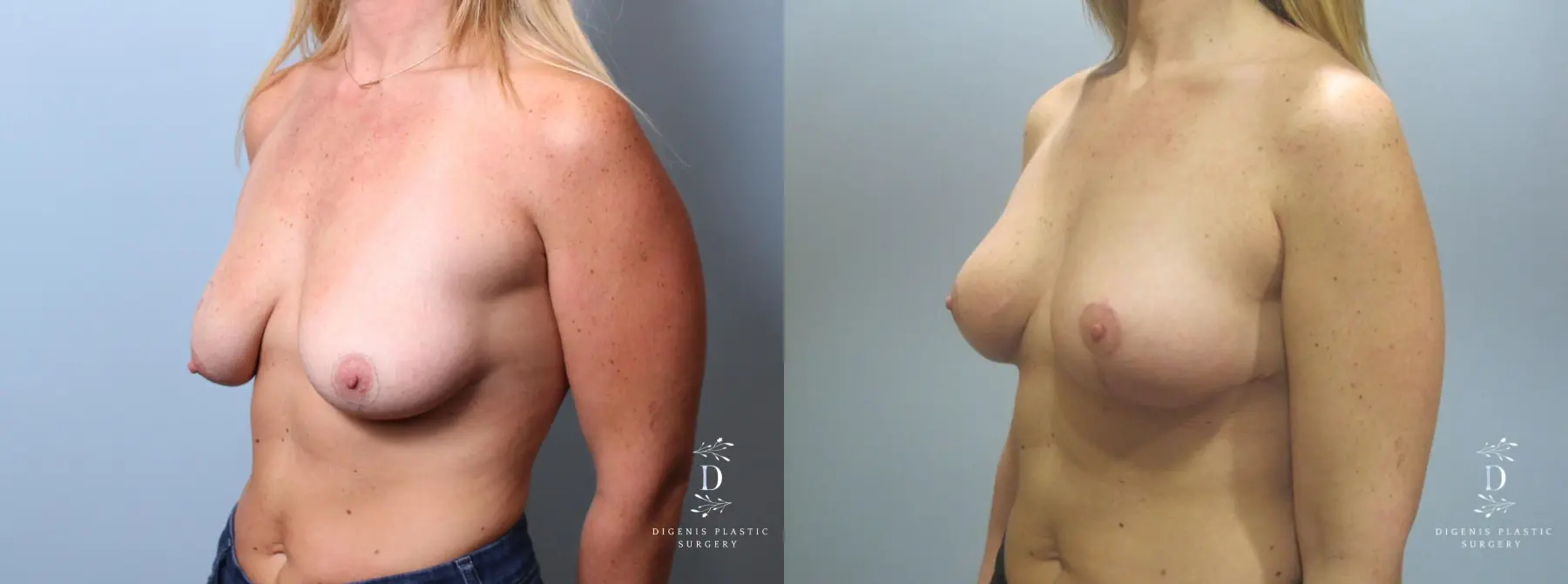 Breast Lift: Patient 7 - Before and After 4