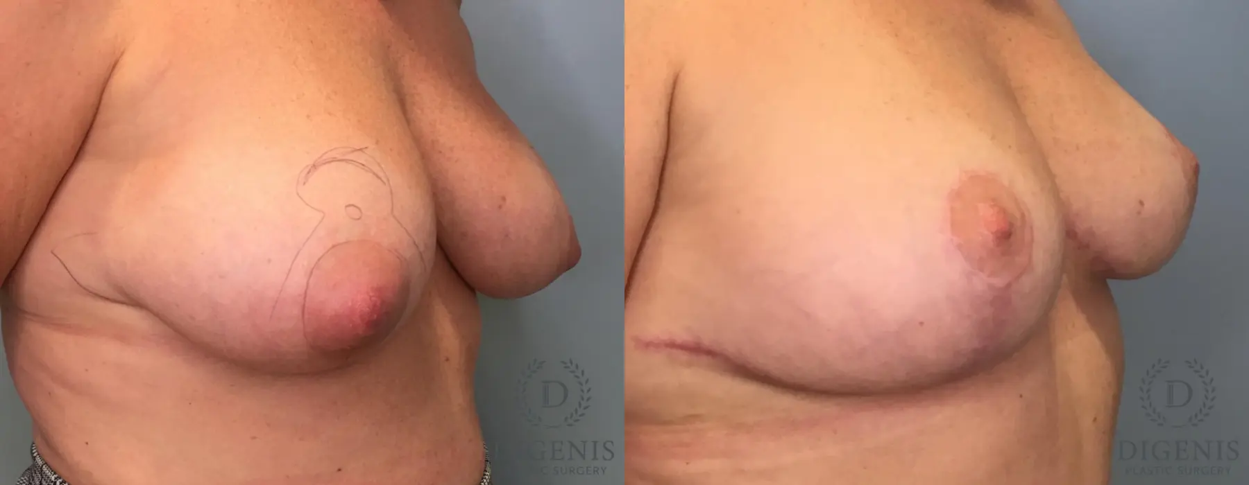 Breast Lift: Patient 42 - Before and After 2