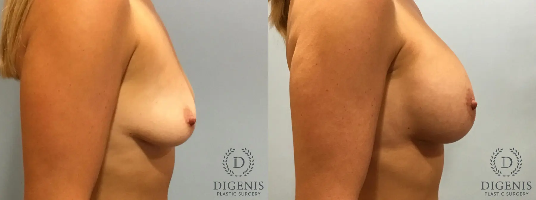 Breast Lift: Patient 13 - Before and After 3