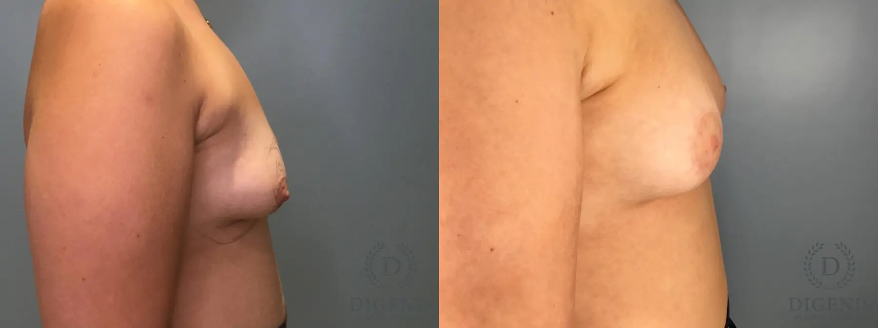 Breast Lift: Patient 7 - Before and After 3