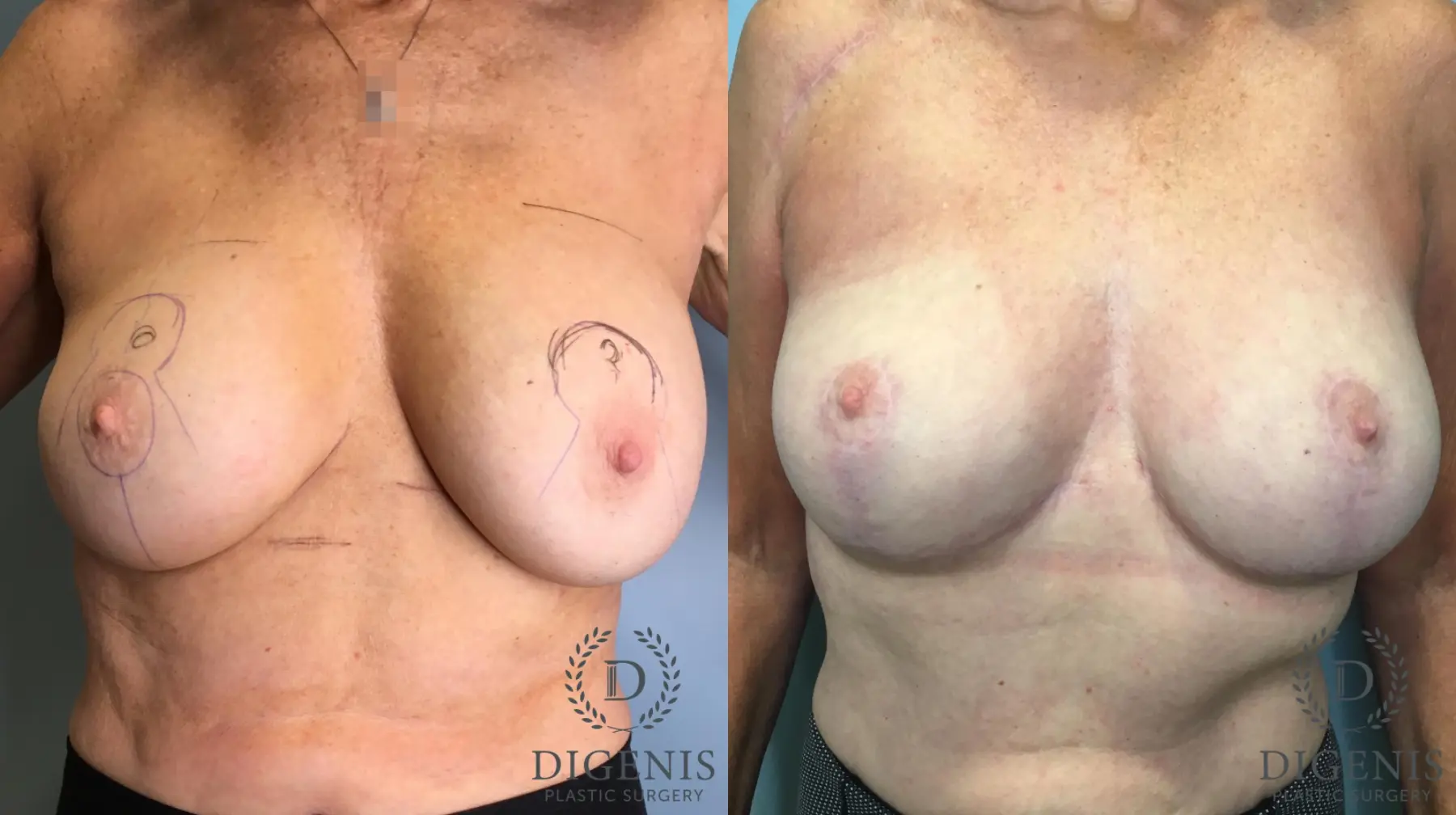 Breast Lift: Patient 4 - Before and After  