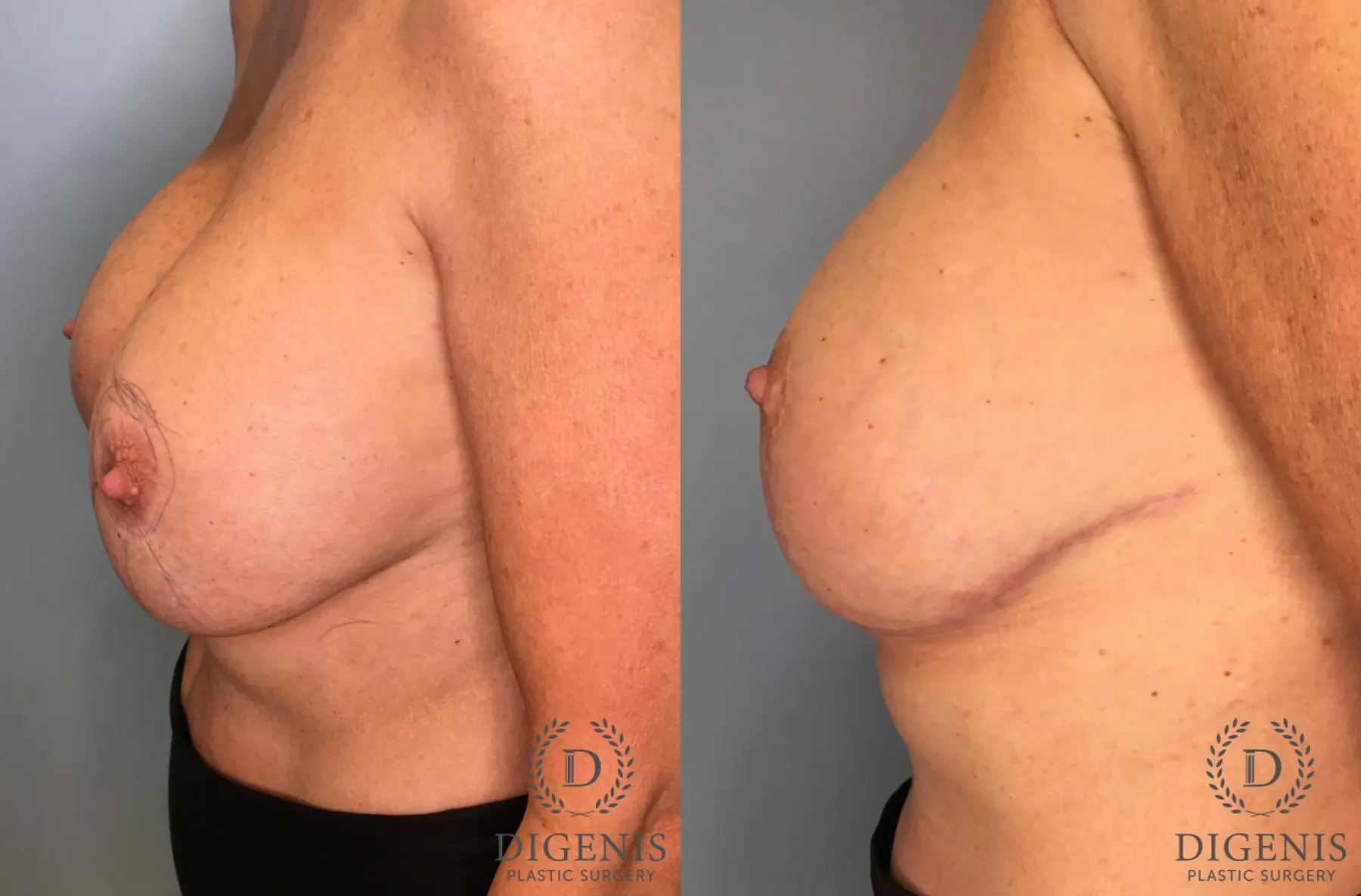 Breast Lift: Patient 41 - Before and After 4