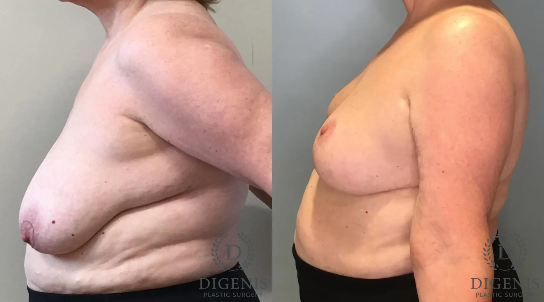 Breast Lift: Patient 36 - Before and After 3