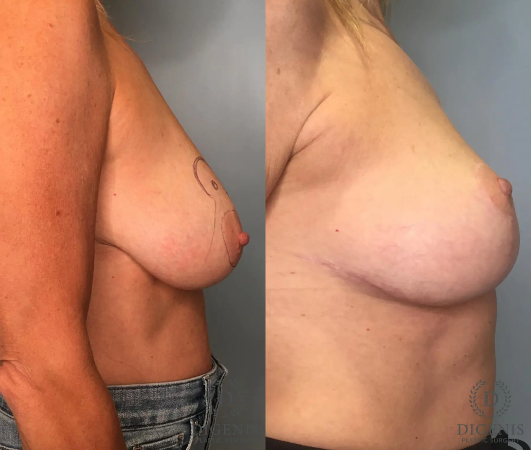 Breast Lift: Patient 5 - Before and After 2