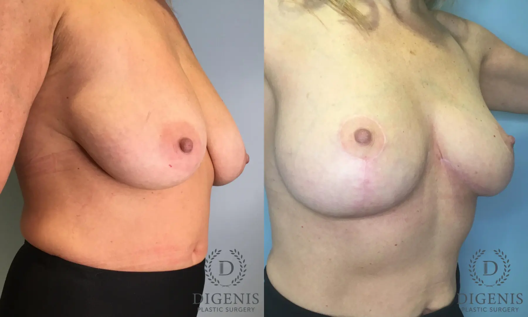 Breast Lift: Patient 5 - Before and After 4