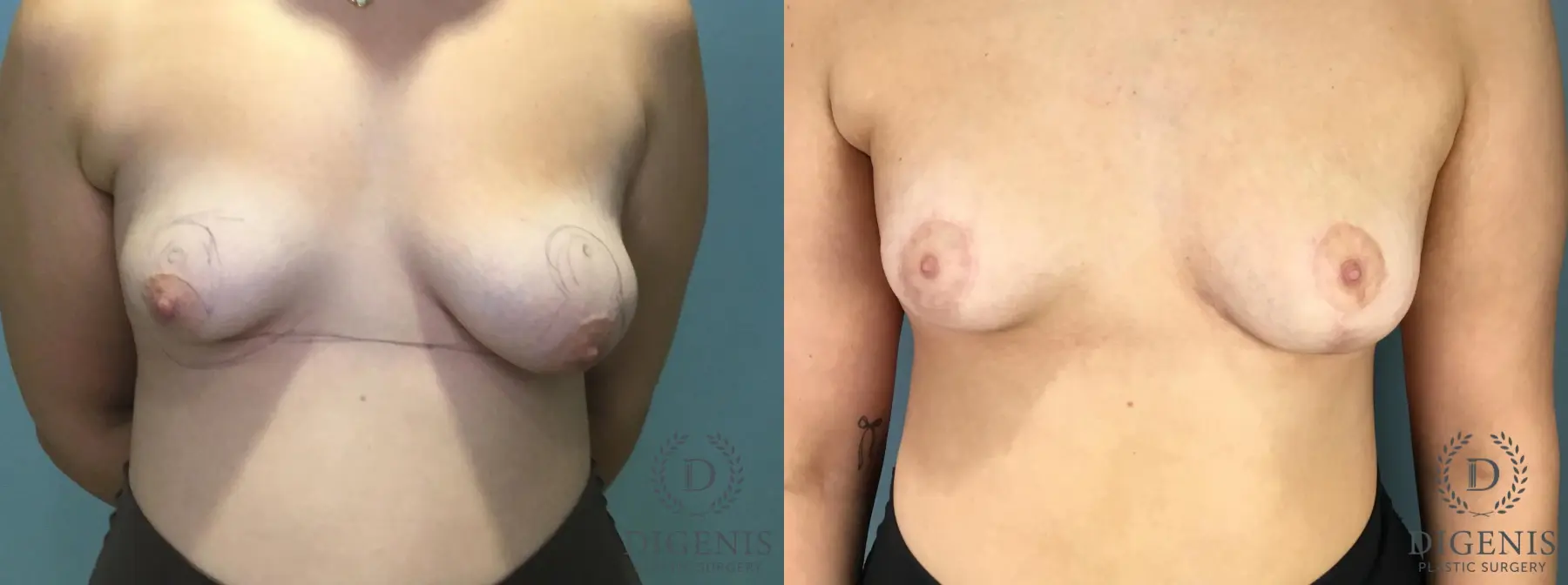 Breast Lift: Patient 7 - Before and After  