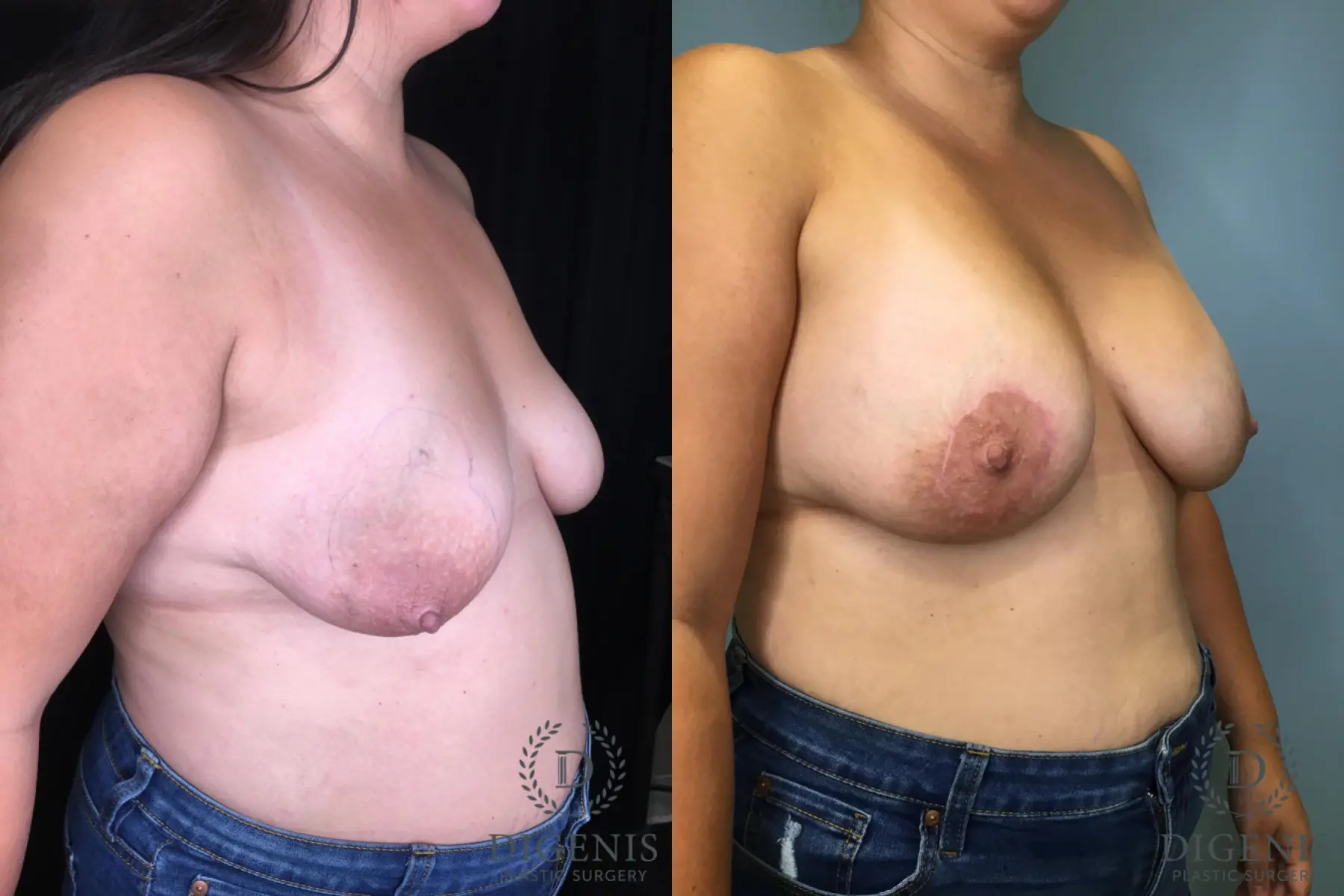Breast Lift: Patient 34 - Before and After 4