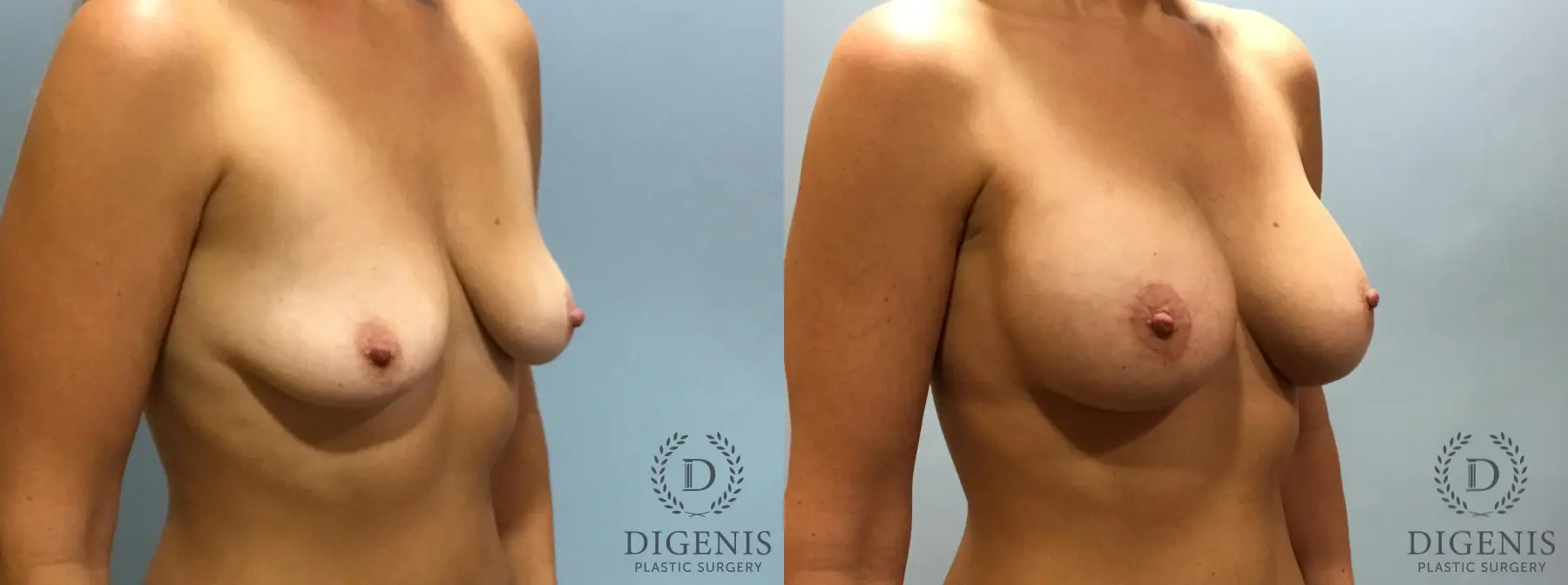 Breast Lift: Patient 13 - Before and After 2