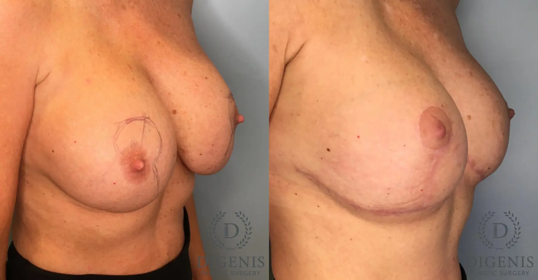 Breast Lift: Patient 41 - Before and After 3