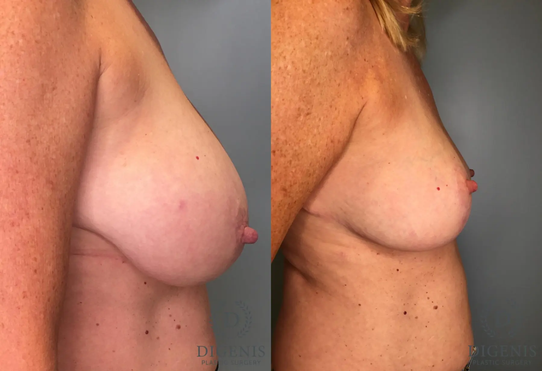 Breast Lift: Patient 39 - Before and After 3