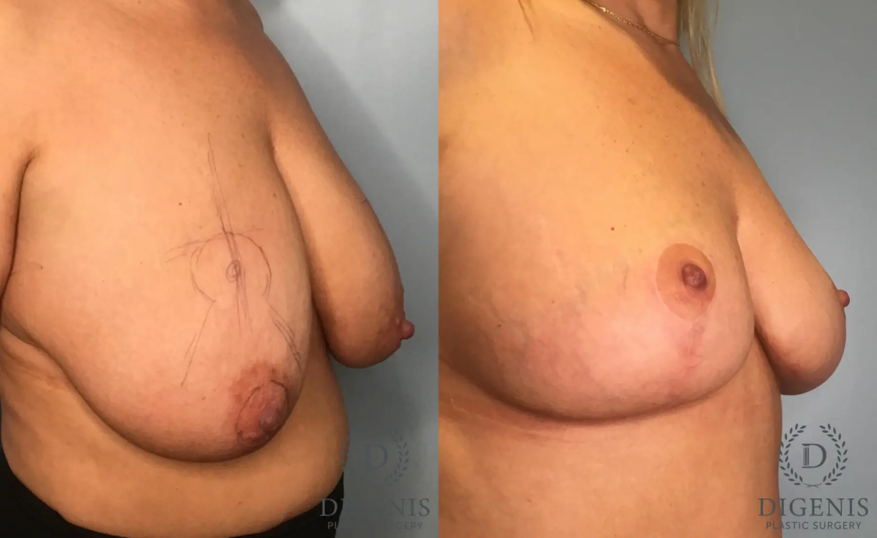 Breast Lift: Patient 44 - Before and After 2