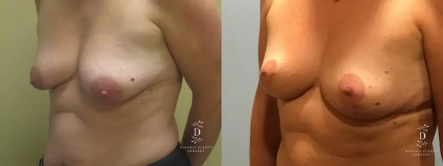 Breast Lift: Patient 9 - Before and After 1