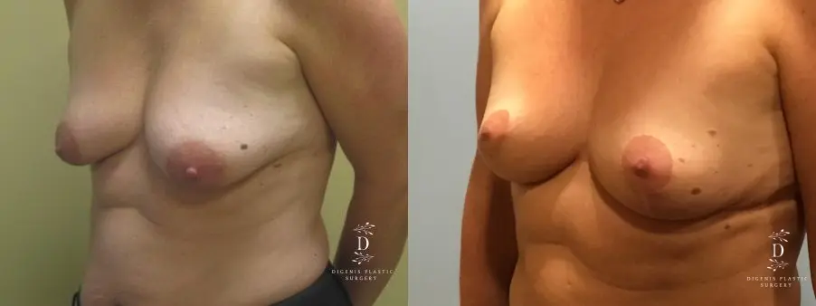 Breast Lift: Patient 9 - Before and After  