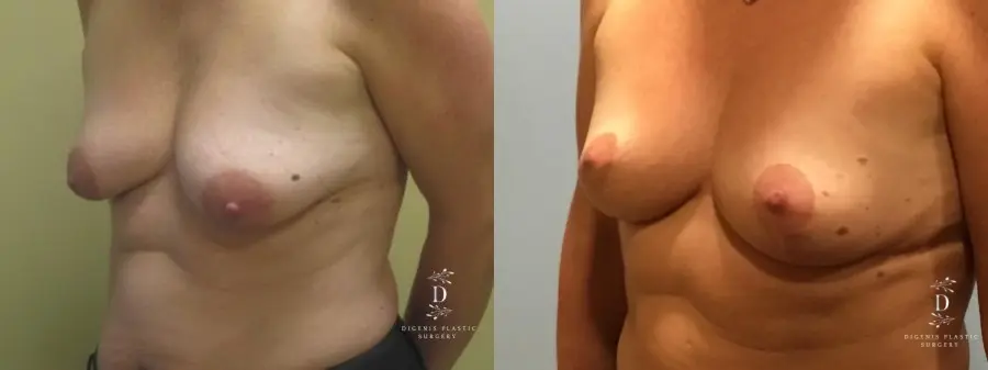 Breast Lift: Patient 9 - Before and After 1