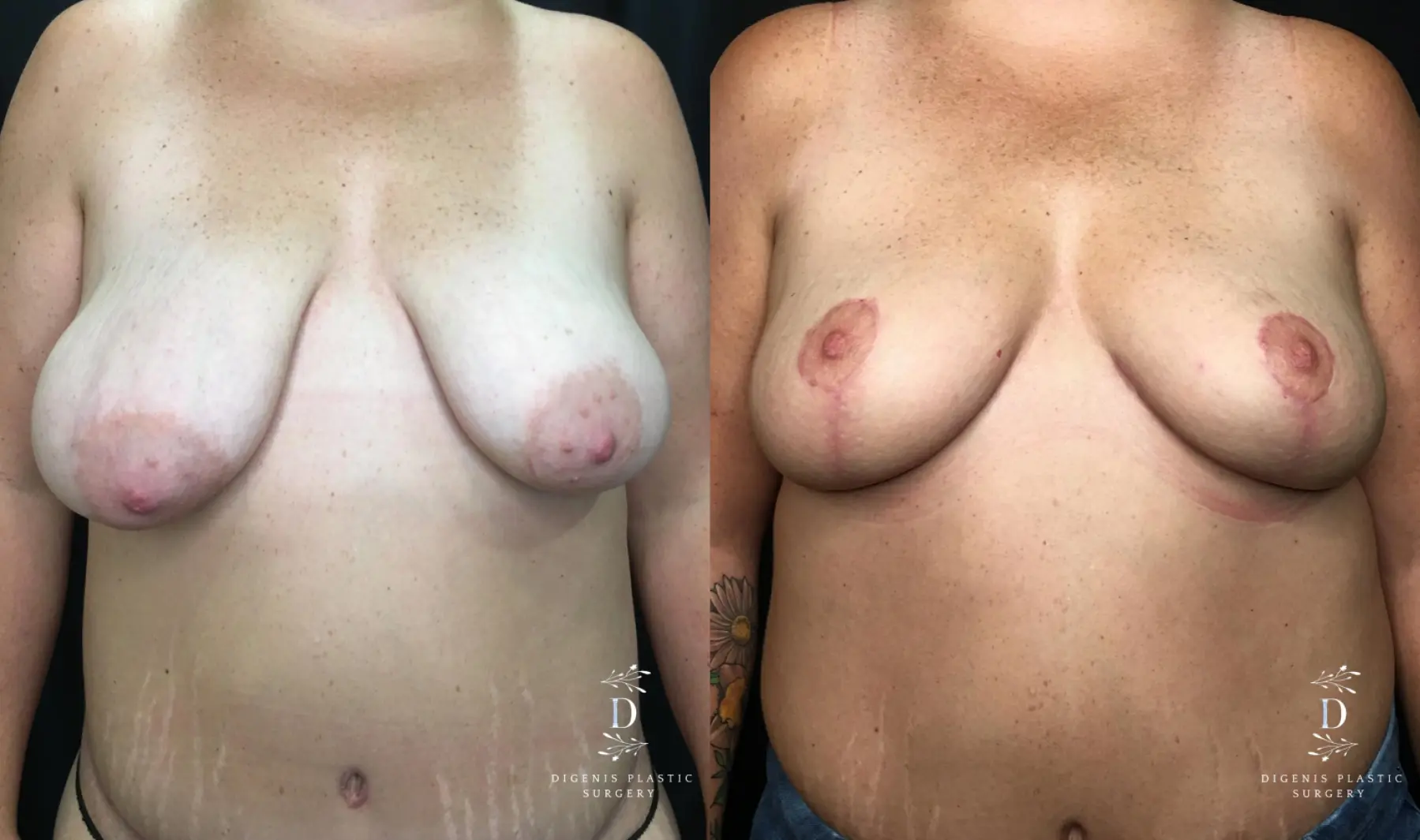 Breast Lift: Patient 10 - Before and After  