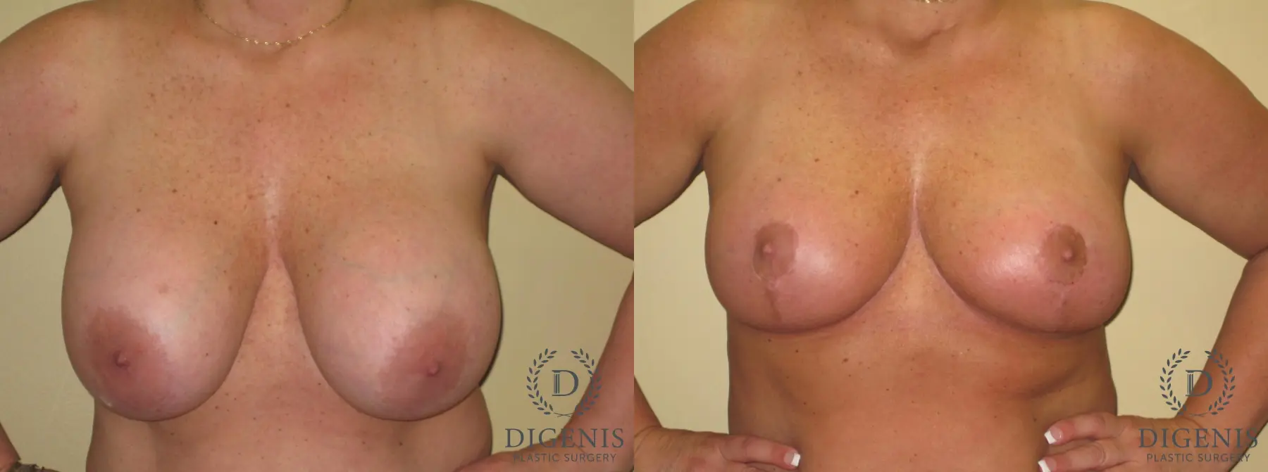 Breast Lift: Patient 18 - Before and After  