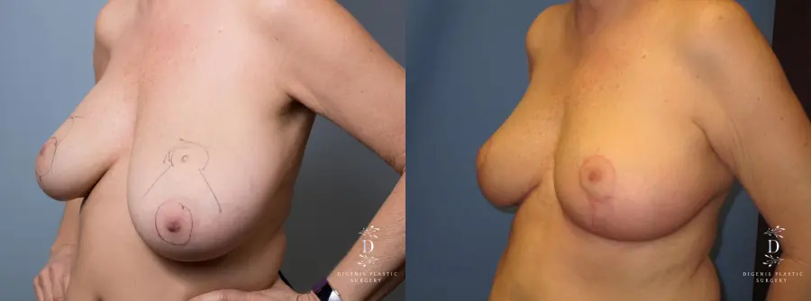 Breast Lift: Patient 6 - Before and After 4
