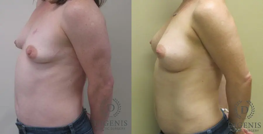 Breast Lift: Patient 7 - Before and After 5