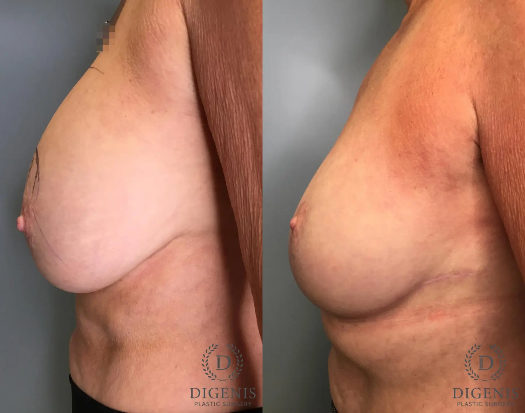 Breast Lift: Patient 4 - Before and After 3