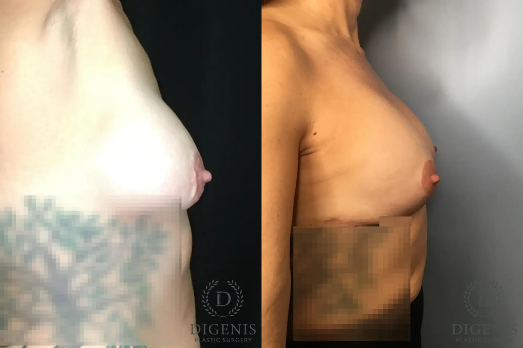 Breast Lift: Patient 37 - Before and After 5