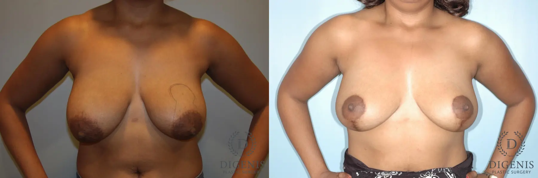 Breast Lift: Patient 2 - Before and After  